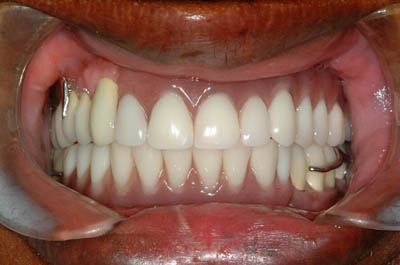Alemu's teeth after
