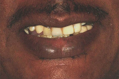 Alemu's teeth before