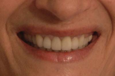 Lynn's teeth after