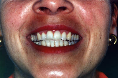 Anna before teeth whitening