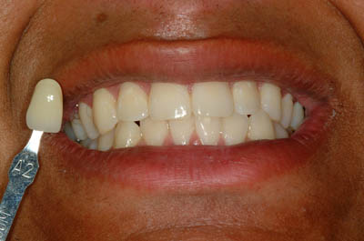 Jaikara before teeth whitening